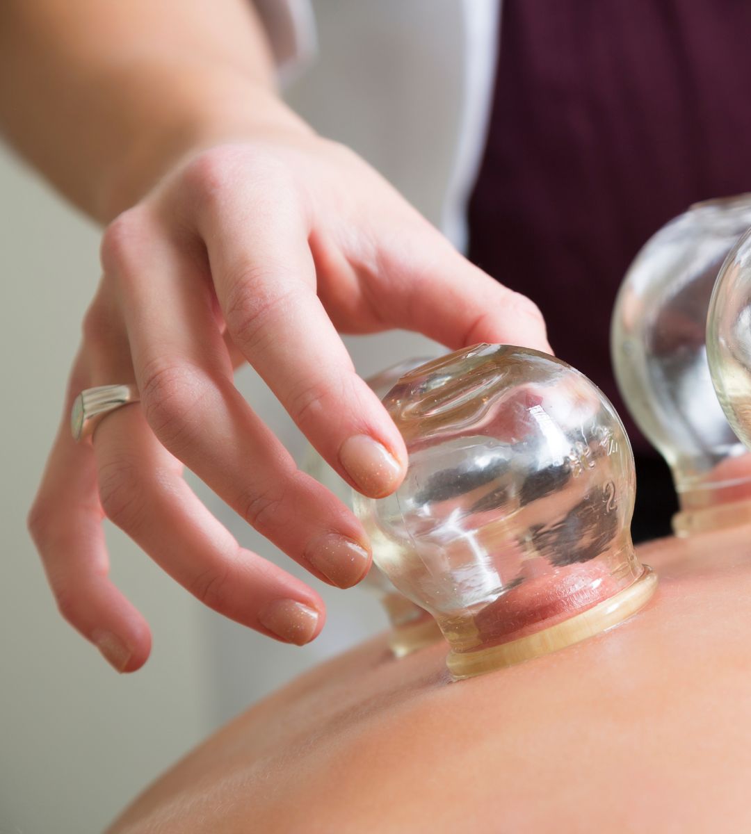 Cupping therapy in Progress